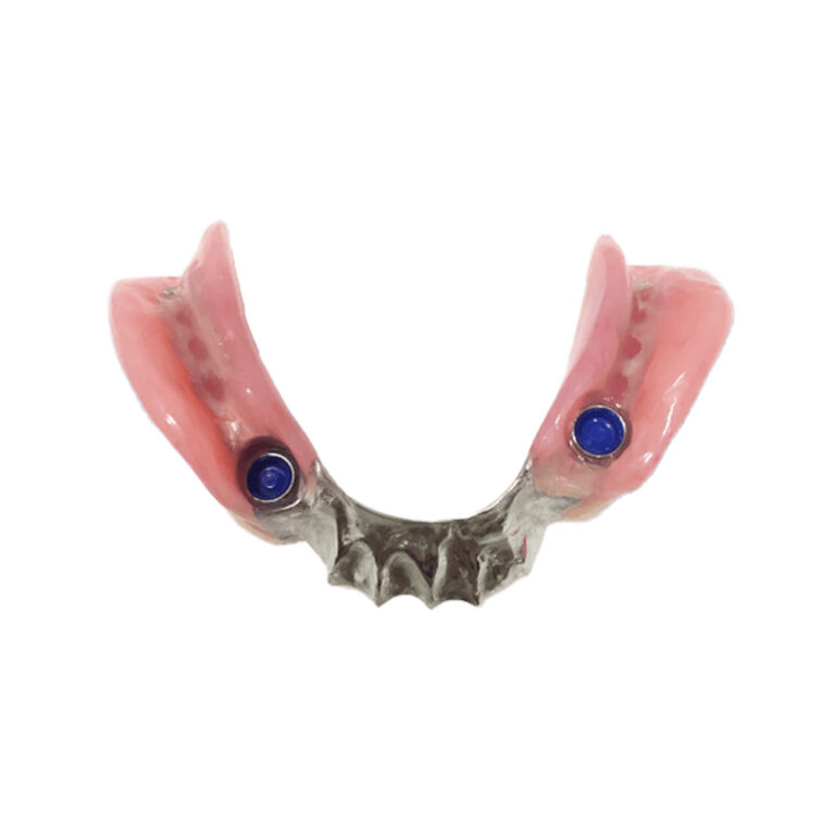 Partial Implant Dentures
