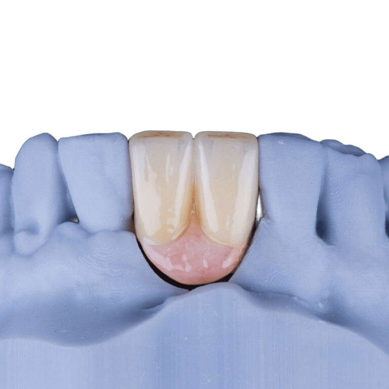 Partial Implant Dentures