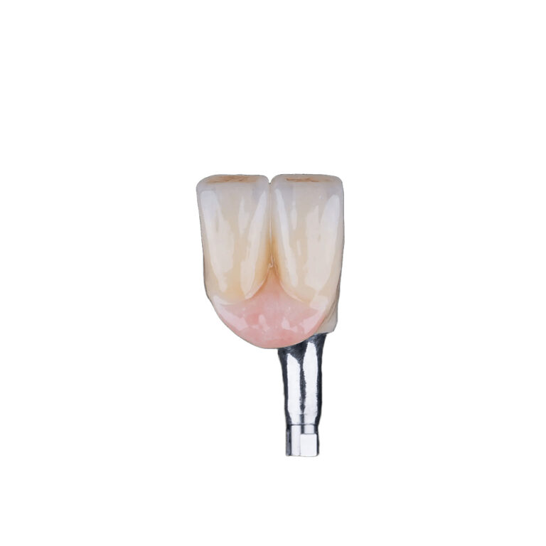 Partial Implant Dentures