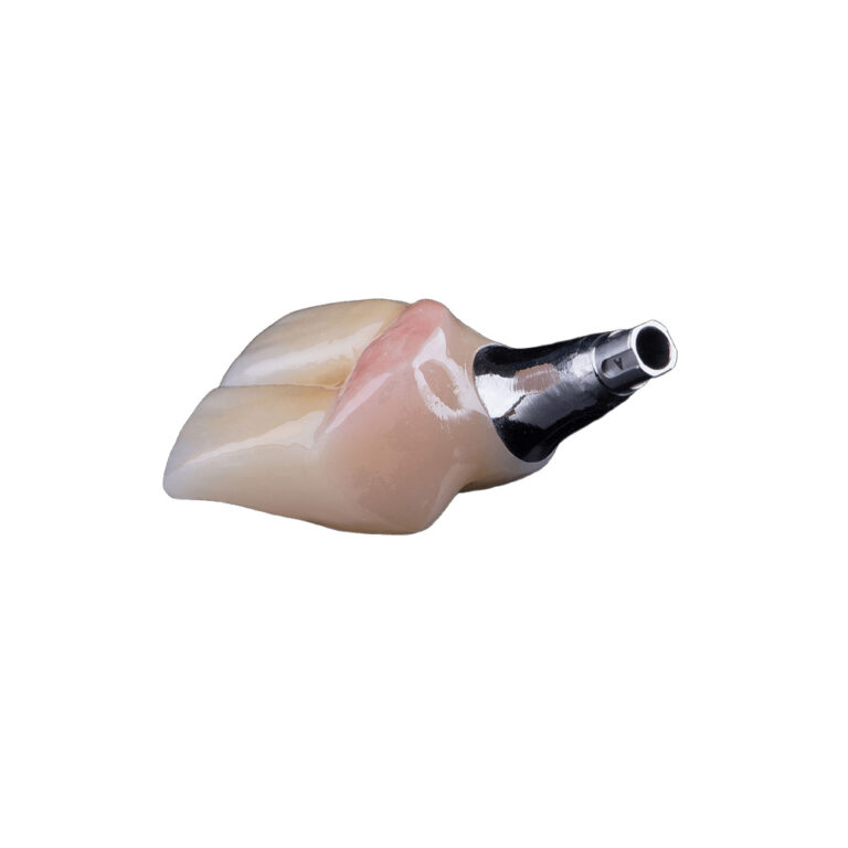 Partial Implant Dentures 4