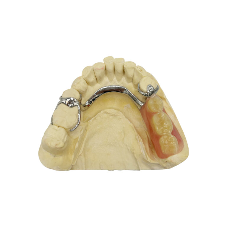 Częściowe protezy metalowe z zatrzaskami