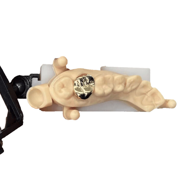 Porcelain Fused to High Noble Metal