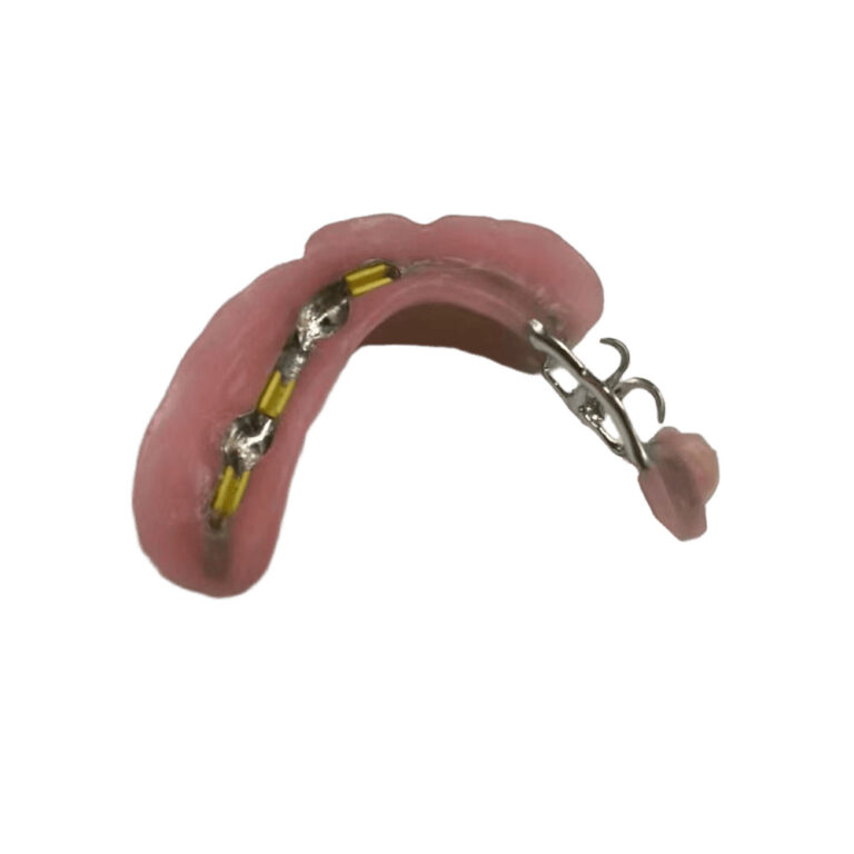 Dentadura parcial con fijación de precisión