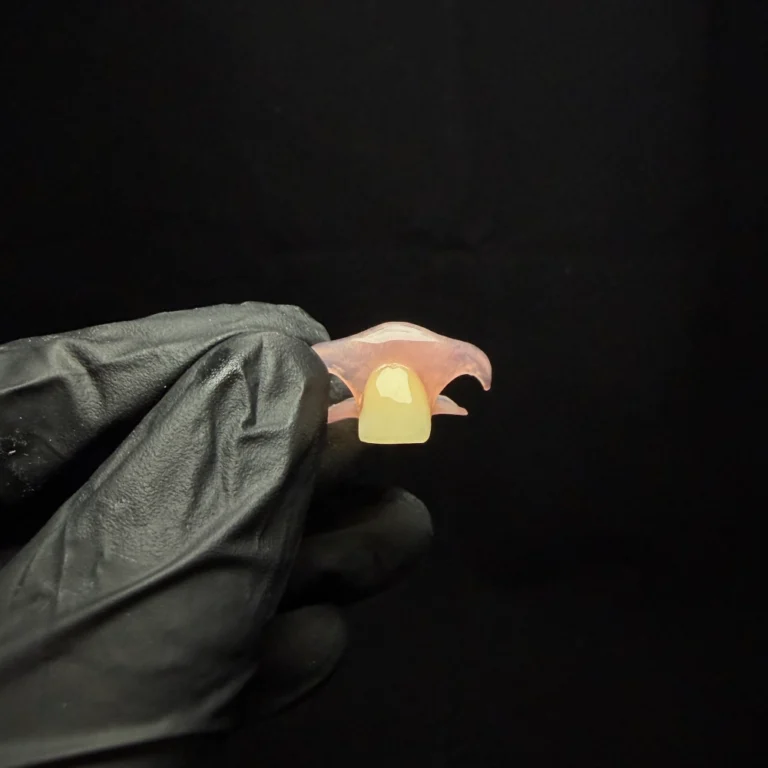 Single Tooth Denture Case (2)