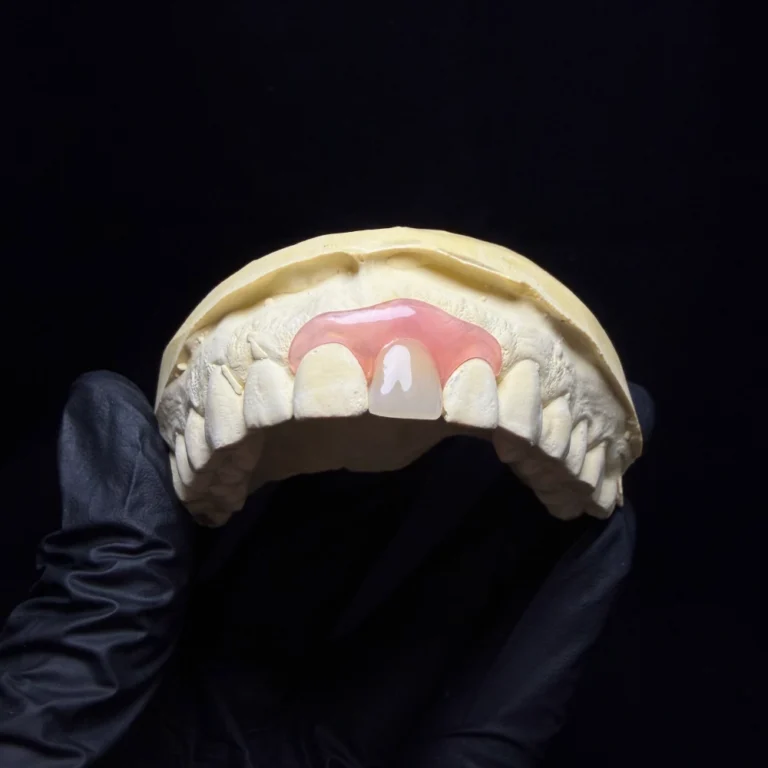 Single Tooth Denture Case