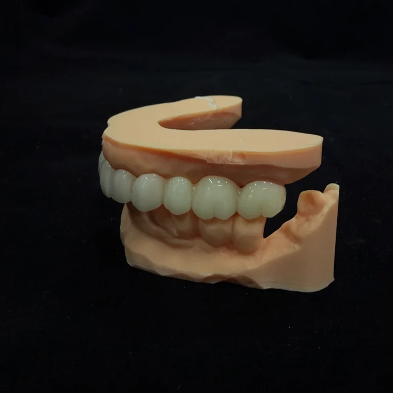 Temporary Bridge Dental (4)
