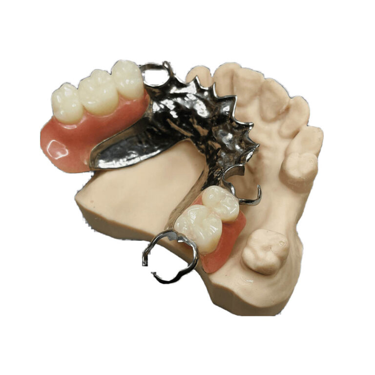 Placas de titanio para prótesis parciales
