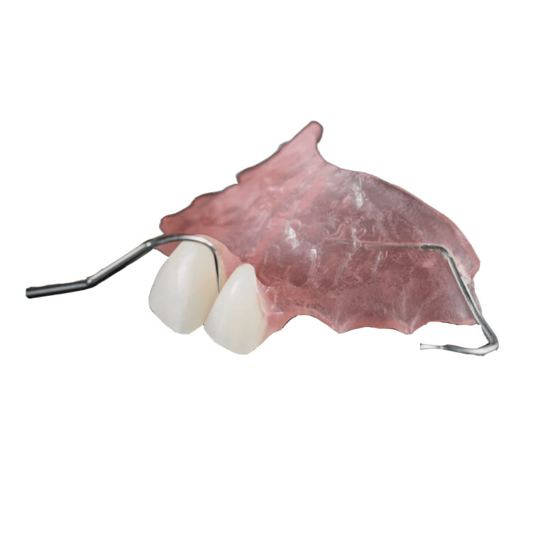 Частични протези за два предни зъба