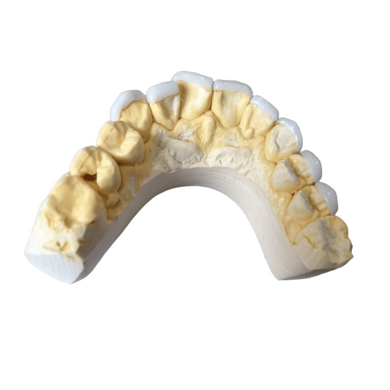 Finér på over- og undertænder