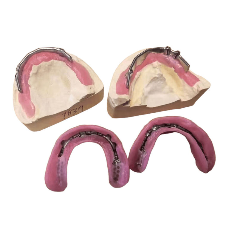 상악 임플란트 틀니