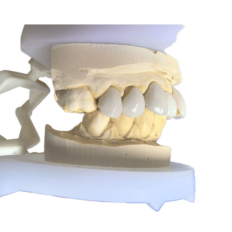 Finér på overtænder