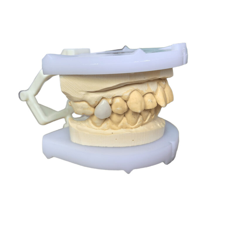 Veneer For One Tooth