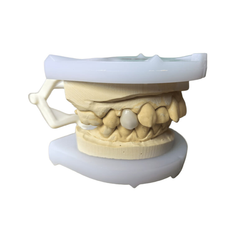 Veneer For One Tooth