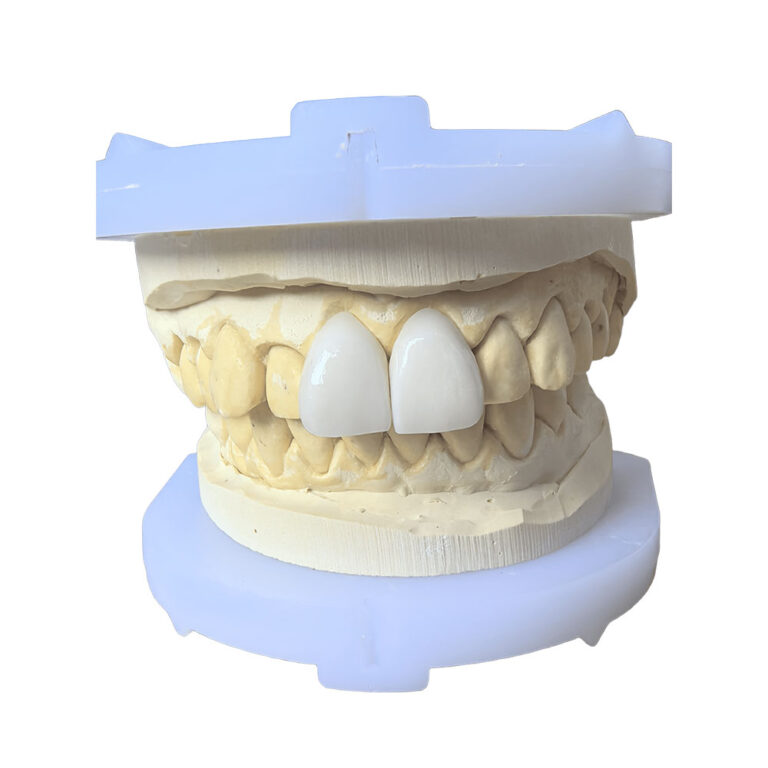 Veneers For Big teeth