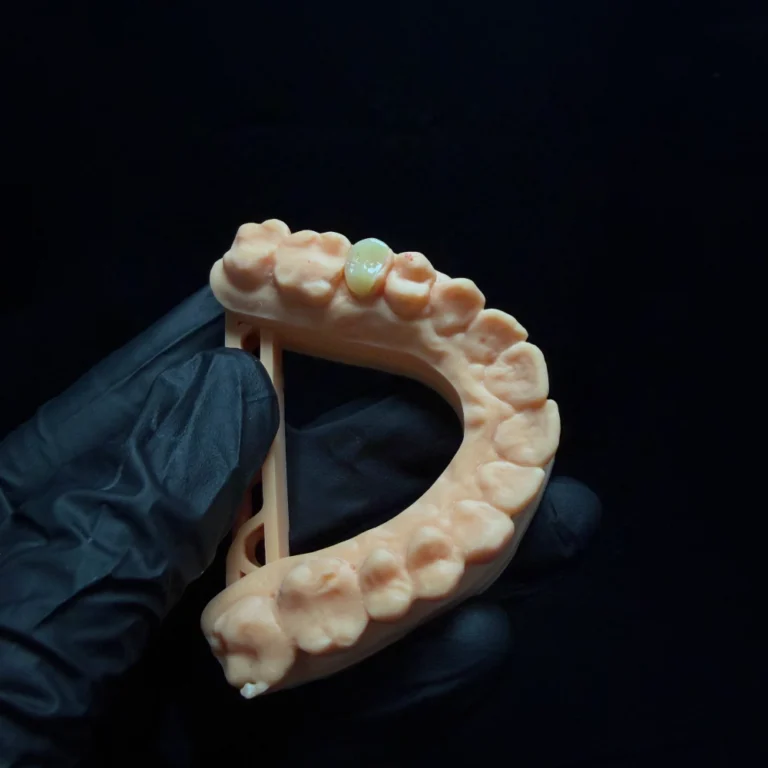 Zirconia Inlay case (1)