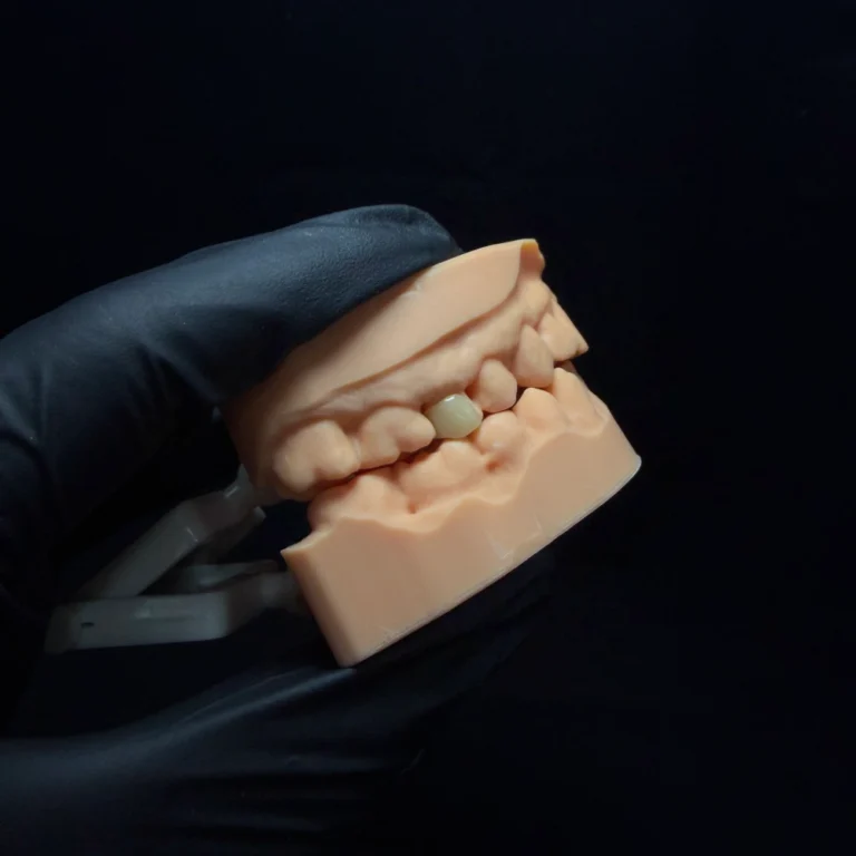 Zirconia Inlay case (2)