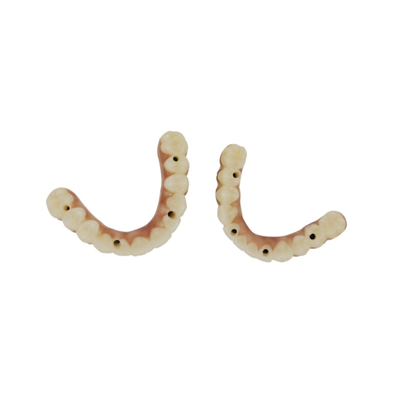 Zirconia Screw Retained Implant Crown