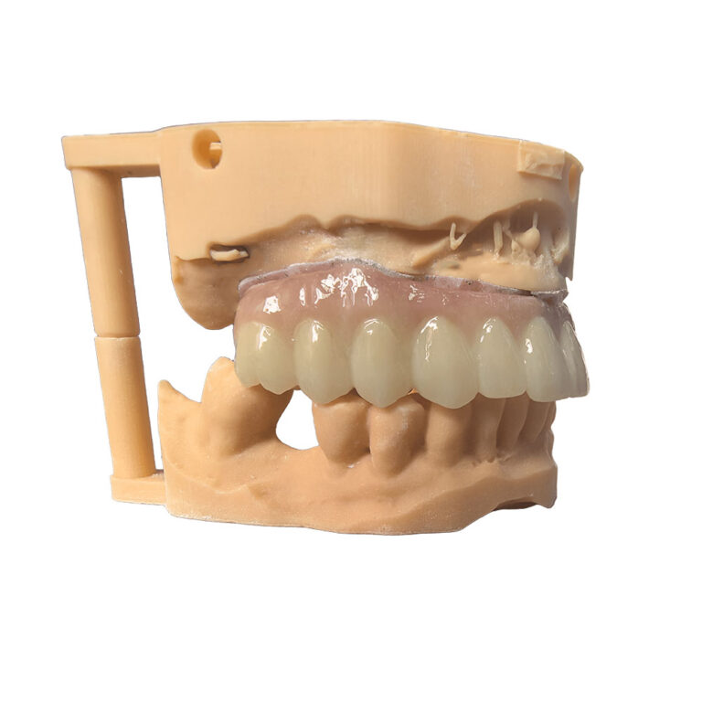 tous sur 4 implants en zircone