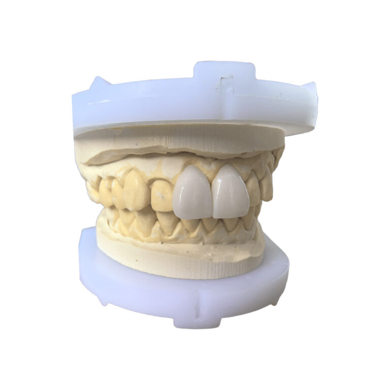 anterior veneer