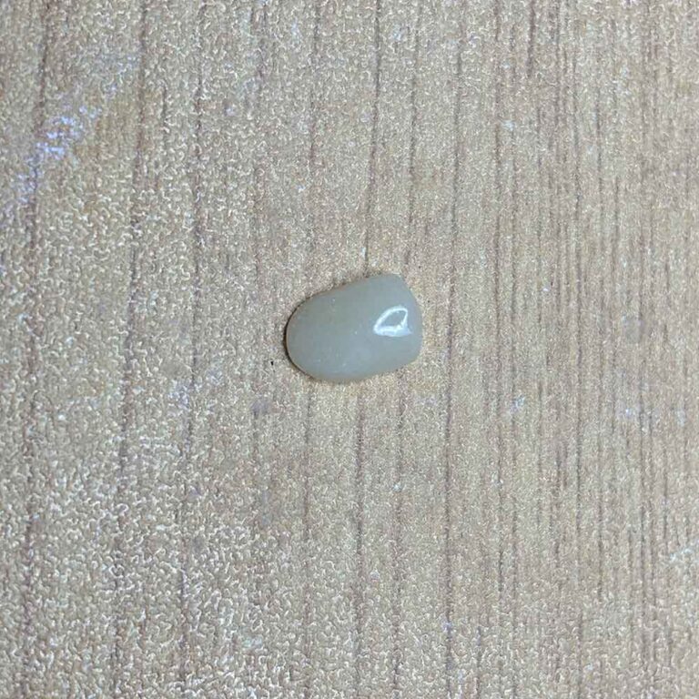 composite dental veneers