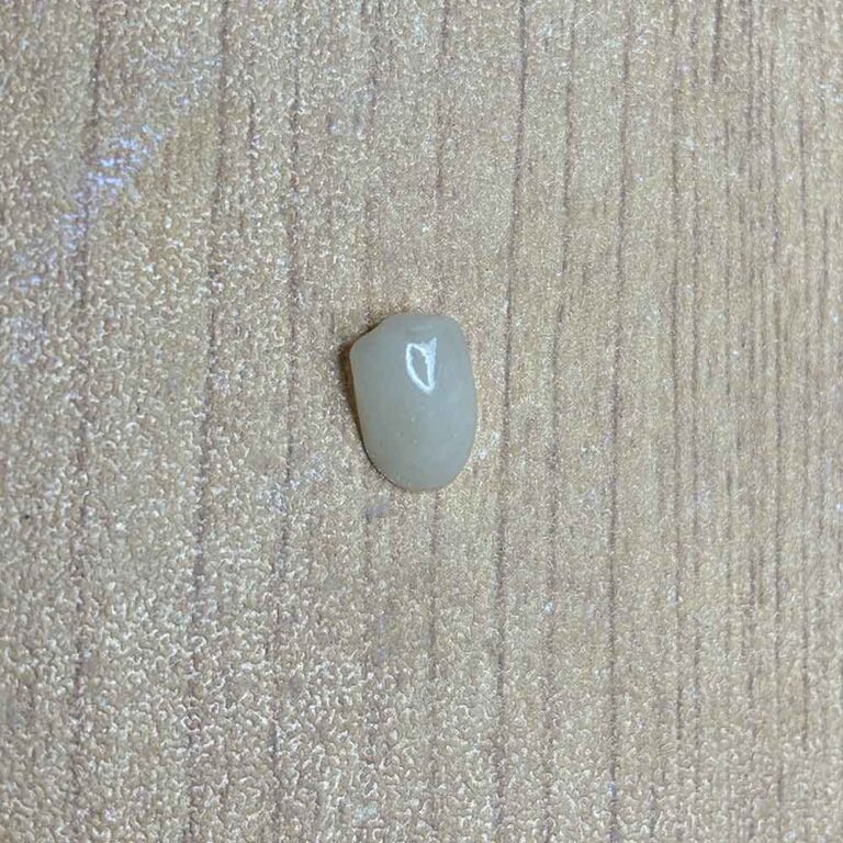 composite resin veneers