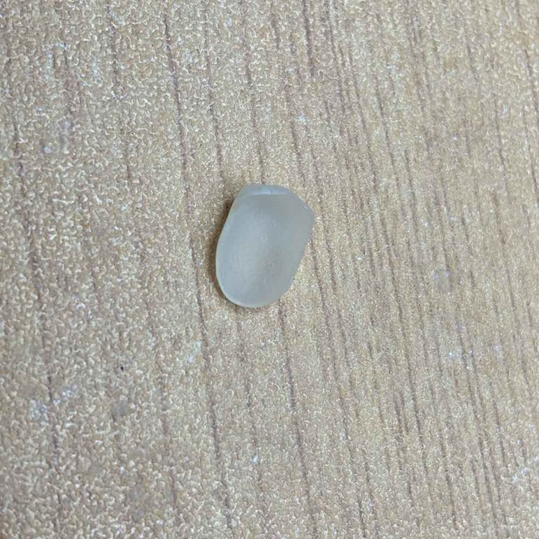 composite resin veneers