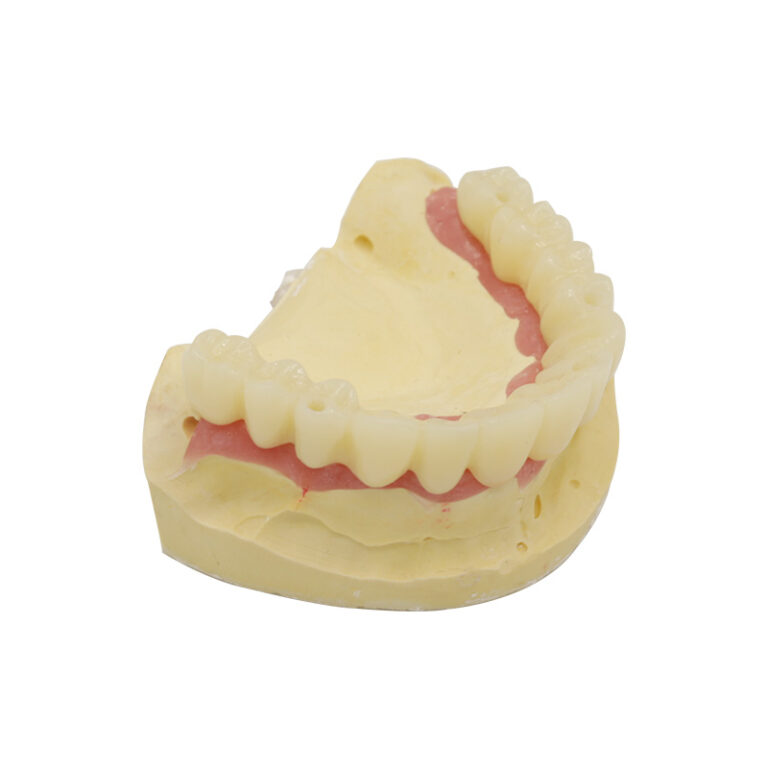 implant temporary bridge