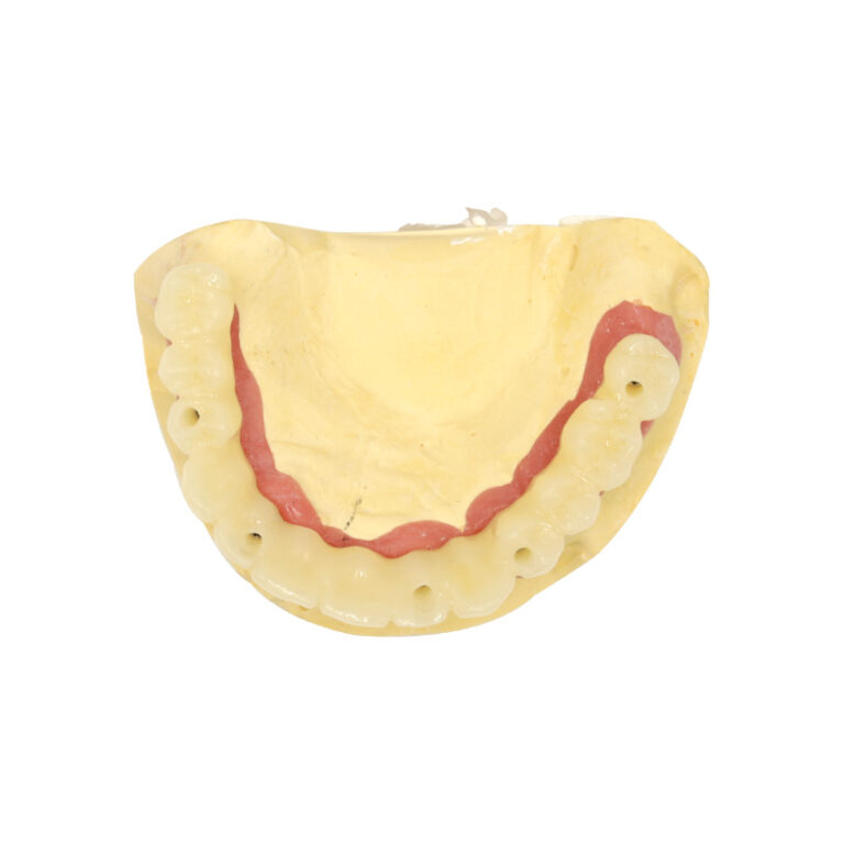implant temporary bridge