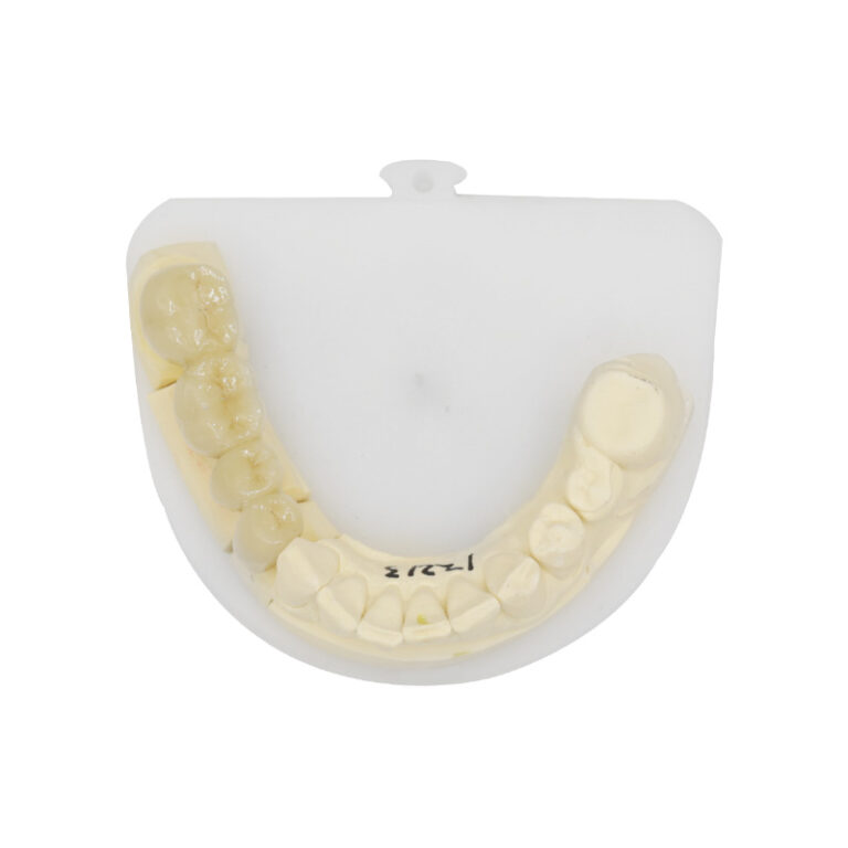 pfm brücke posterior