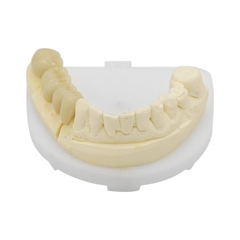 pfm brücke posterior