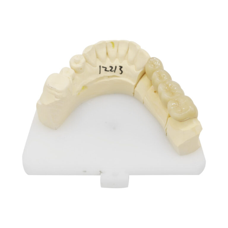 pfm brücke posterior