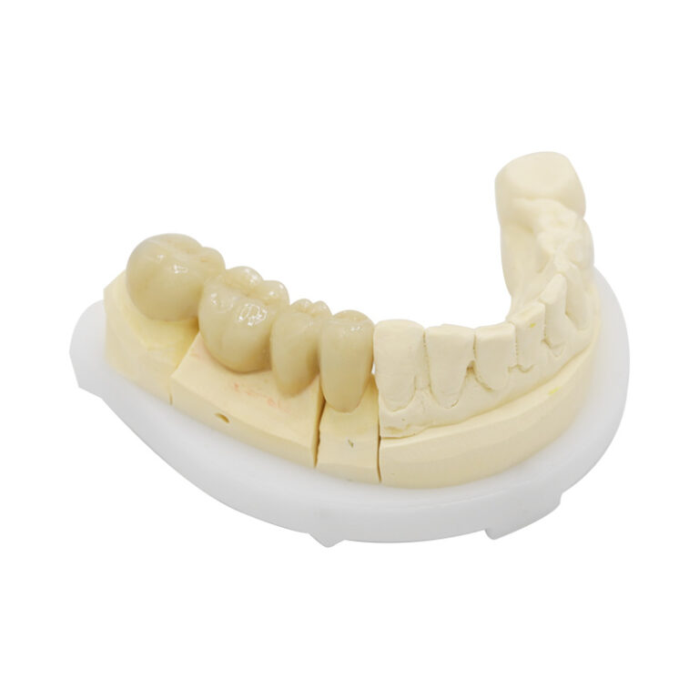 pfm brücke posterior