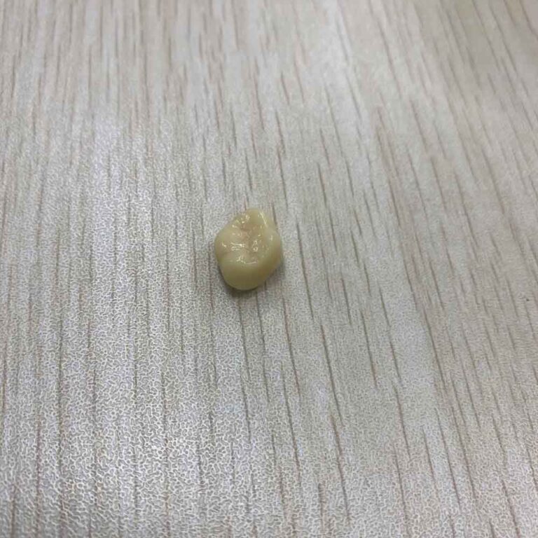 denti inferiori provvisori