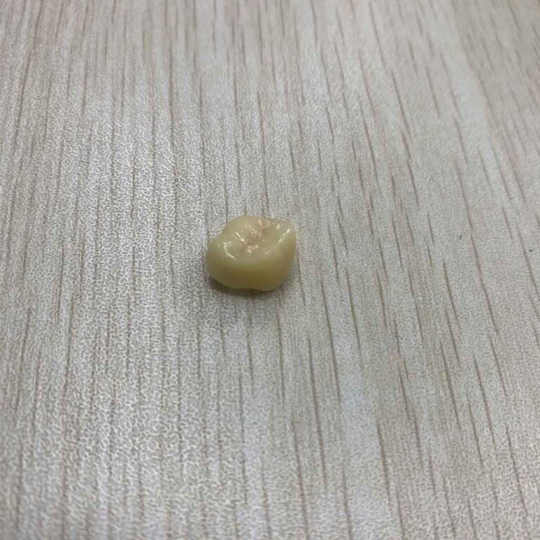 denti inferiori provvisori