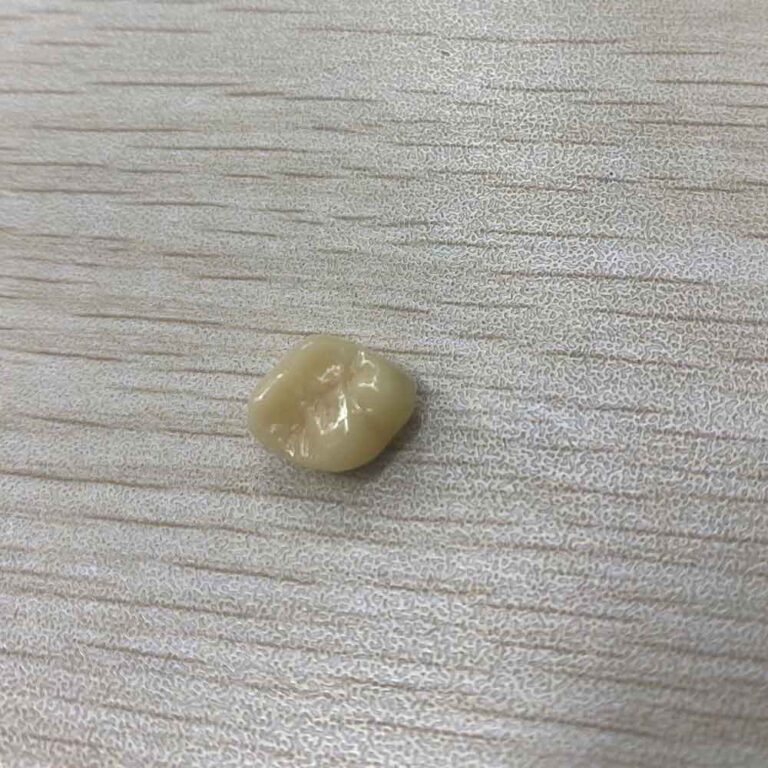 denti inferiori provvisori