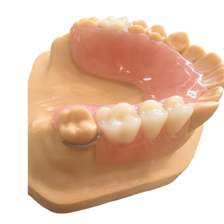 transitional partial denture