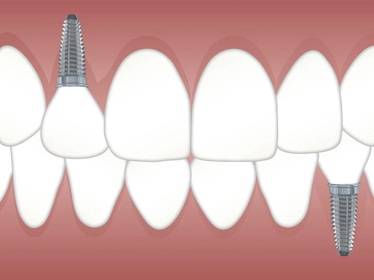 Pilares para implantes dentales