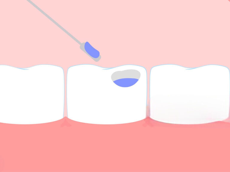 Зъбни пломби