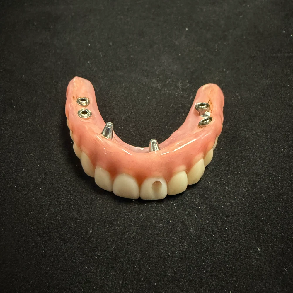 Implant Supported Dentures (1)