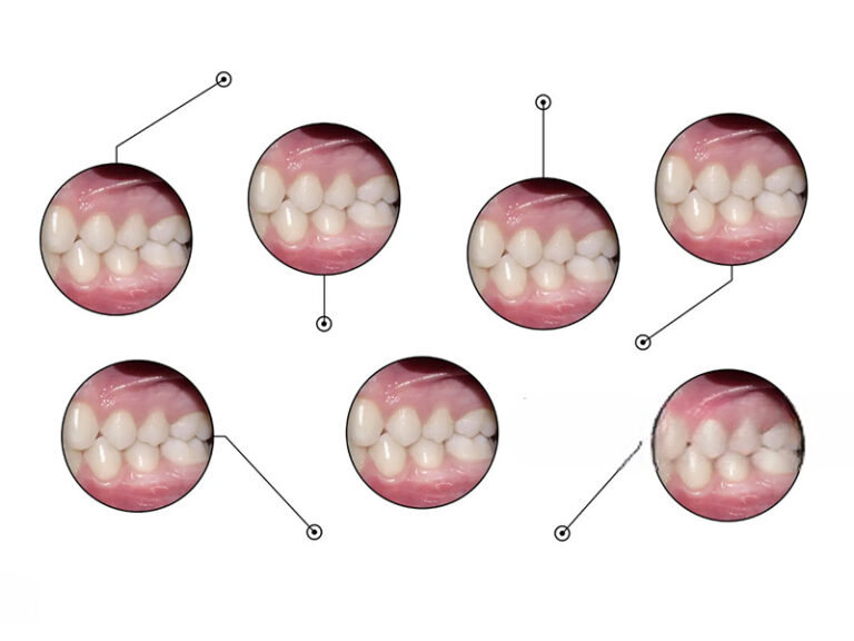 Ortodonzia con apparecchio di ritenzione del dente