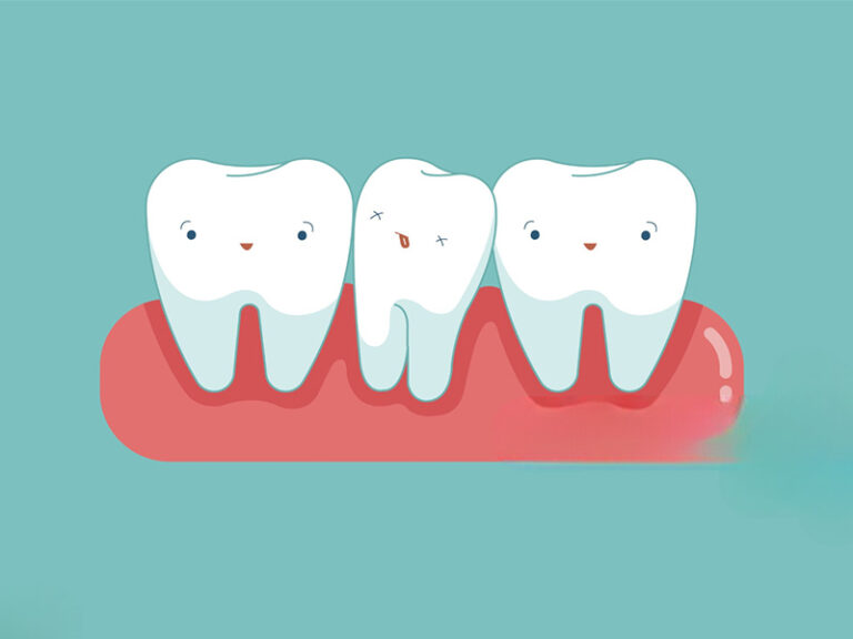 Comprendre l'hypodontie