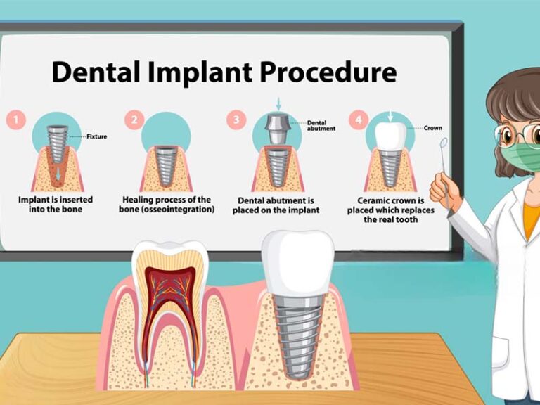 Comprender la cronología del proceso de implante dental