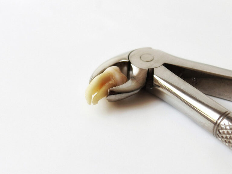 Rimozione dei denti del giudizio