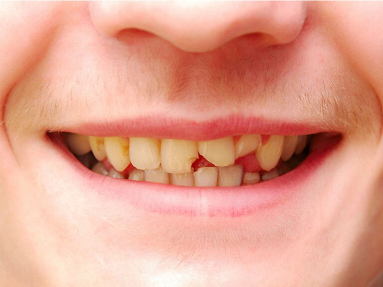 Come individuare e affrontare un dente incrinato