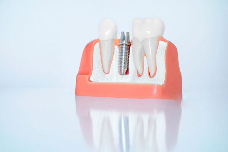 Revêtements de surface des implants pour une croissance osseuse plus rapide (1)
