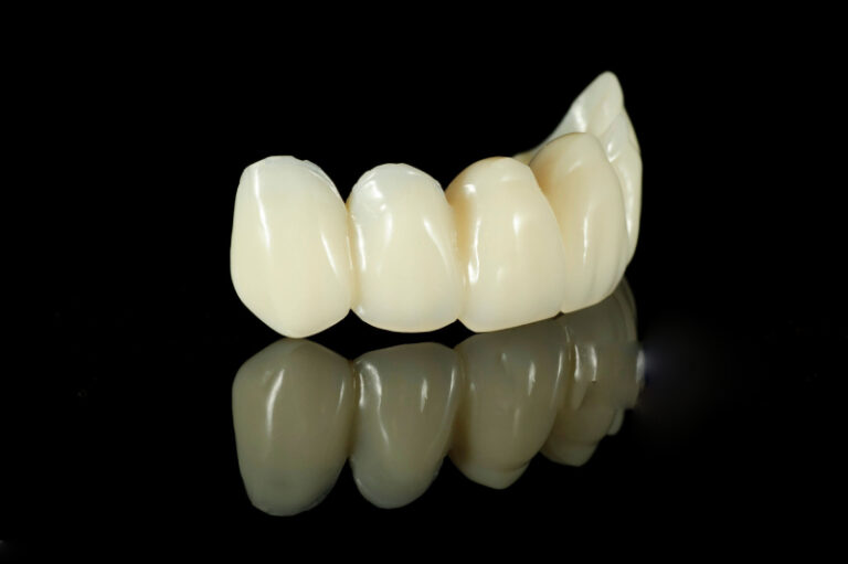 Corone in zirconia multistrato e caratterizzazione del bordo incisale (1)