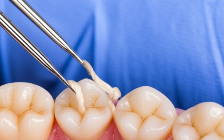 Double cord technique dental impression preparation