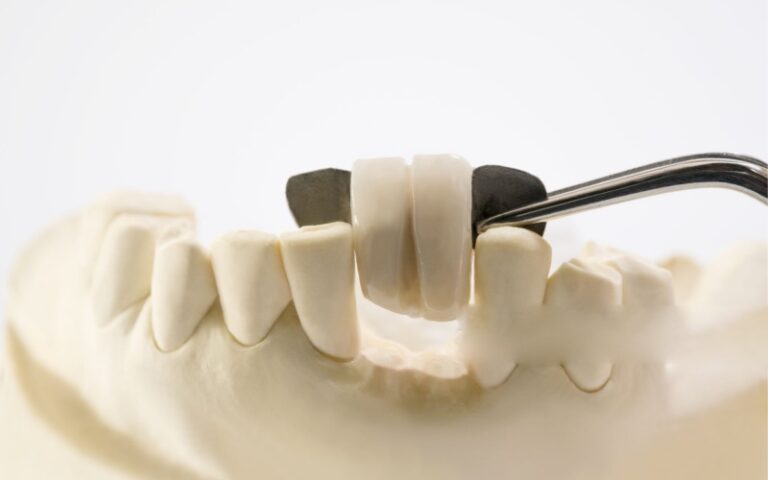 Puente dental Maryland sobre dientes delanteros modelo