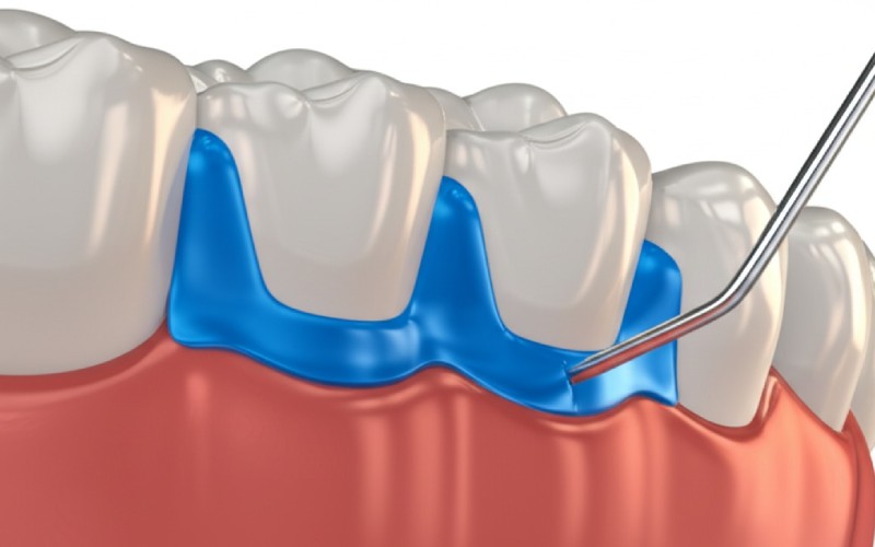 Matrix band supporting dental composite restoration