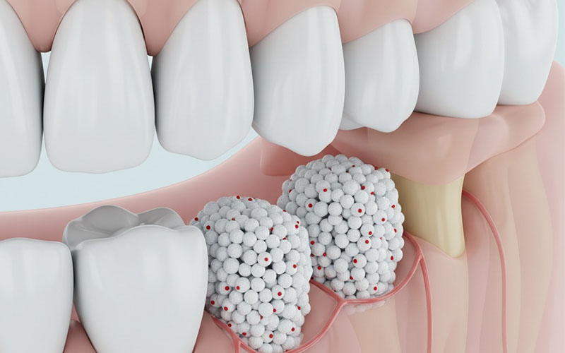 3D illustration of bone grafting
